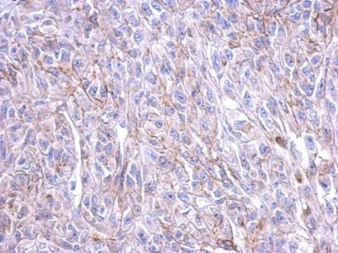 Immunohistochemistry-Paraffin: CRHR1/CRF1 Antibody [NBP2-16010] - Immunohistochemical analysis of paraffin-embedded HeLa xenograft, using antibody at 1:500 dilution.