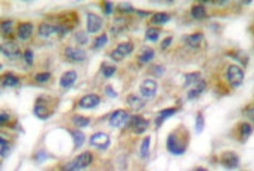 Immunohistochemistry-Paraffin: Granzyme B/H Antibody [NB100-91792] - Paraffin-embedded human breast carcinoma tissue.