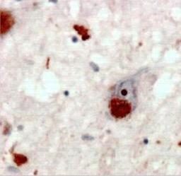 Immunohistochemistry-Paraffin: Poly-Ubiquitin K63 Linkage Antibody (HWA4C4) [NBP2-36523] - Sections of hippocampus from human Alzheimers disease brain stained at 1:100 dilution with biotinylated secondary antibody and DAB detection.