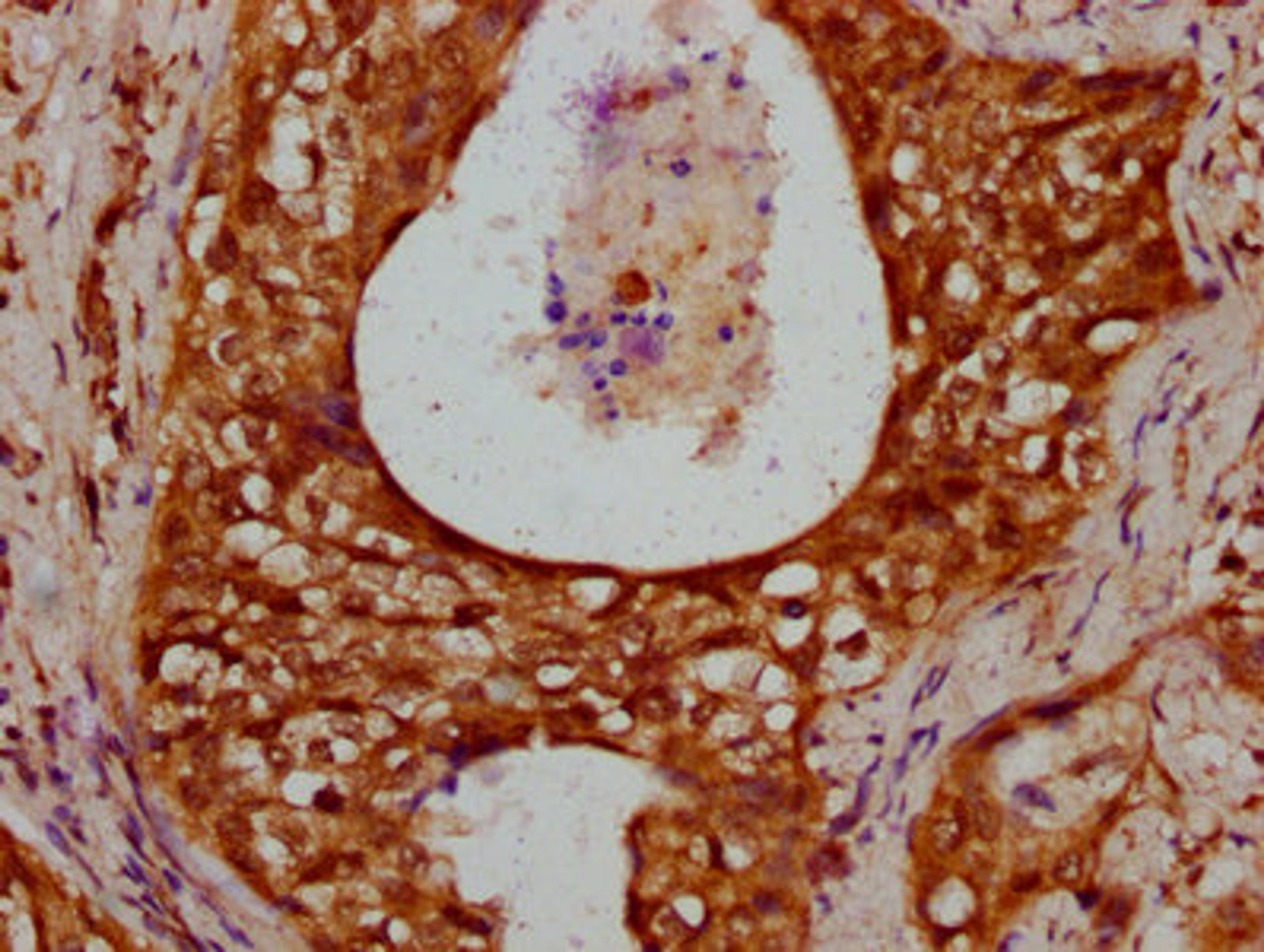 IHC image of CSB-PA010378OA80nhibHU diluted at 1:10 and staining in paraffin-embedded human cervical cancer performed on a Leica BondTM system. After dewaxing and hydration, antigen retrieval was mediated by high pressure in a citrate buffer (pH 6.0). Section was blocked with 10% normal goat serum 30min at RT. Then primary antibody (1% BSA) was incubated at 4&deg;C overnight. The primary is detected by a biotinylated secondary antibody and visualized using an HRP conjugated SP system.