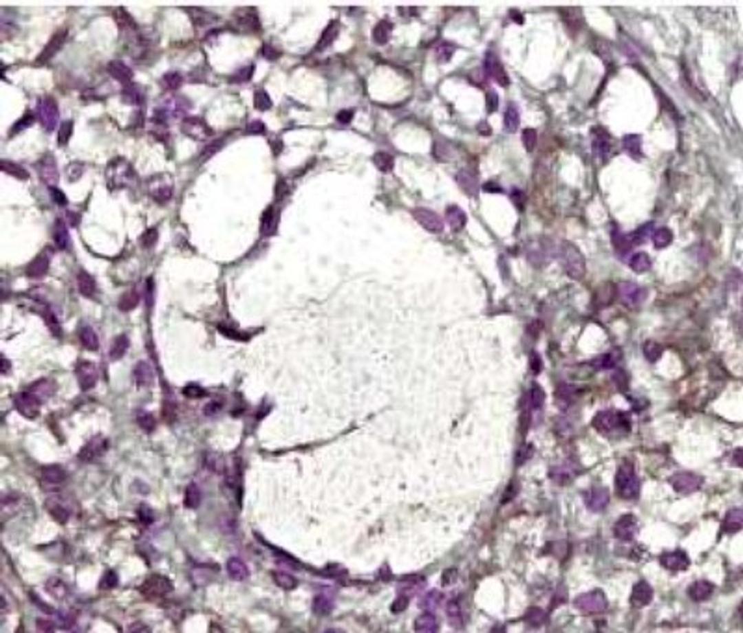 Immunohistochemistry-Paraffin: MMP2 Antibody (8B4) [NB200-114] - Detection of MMP-2 staining in formalin-fixed paraffin-embedded human ovary tissue. Primary antibody was used at 2.5 ug/ml with the avidin-biotin-peroxidase detection method.