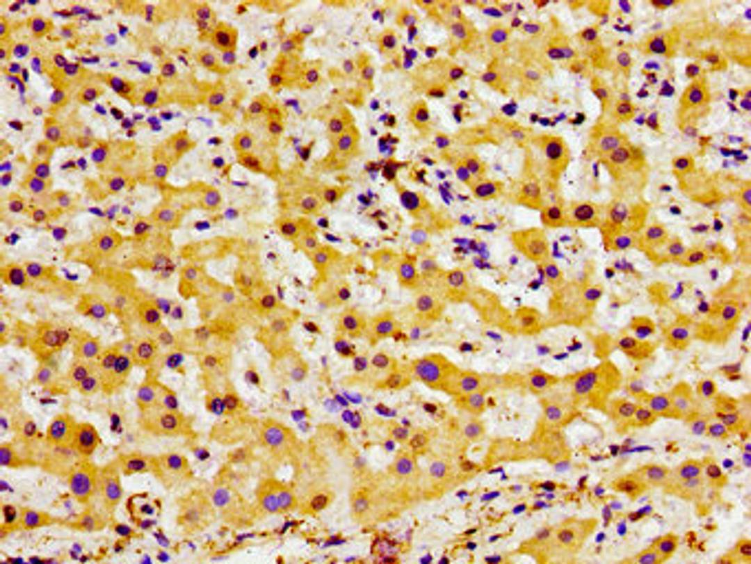 Immunohistochemistry of paraffin-embedded human liver cancer using CSB-PA007919LA01HU at dilution of 1:100