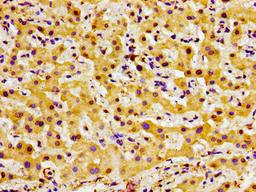 Immunohistochemistry of paraffin-embedded human liver cancer using CSB-PA007919LA01HU at dilution of 1:100