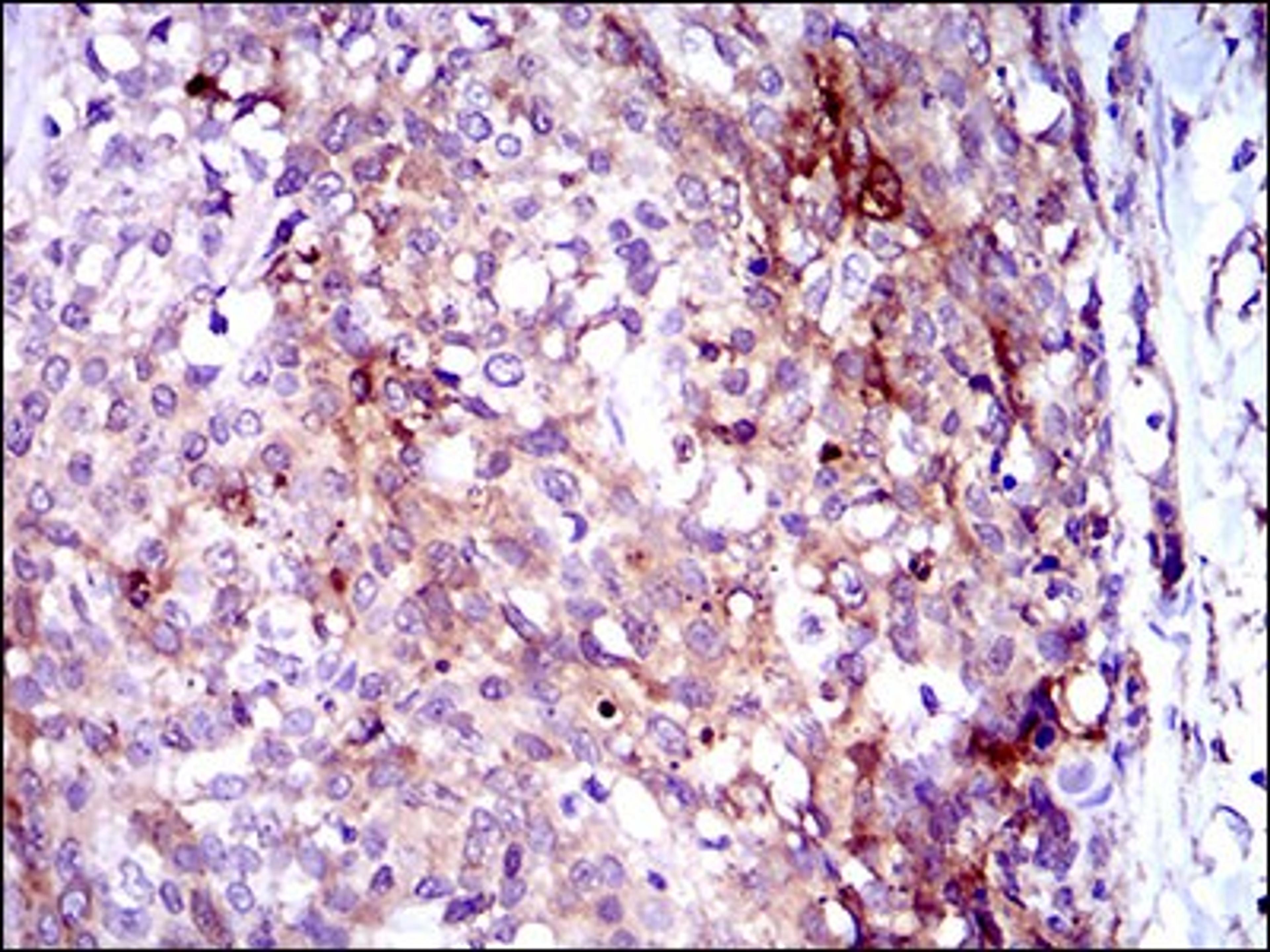 Immunohistochemistry: Osteoactivin/GPNMB Antibody (7C10E5) [NBP2-37351] - Immunohistochemical analysis of paraffin-embedded esophagus cancer tissues using GPNMB mouse mAb with DAB staining.