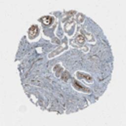 Immunohistochemistry: STOML3 Antibody [20760002] - Cells in lymphoid follicles were negative. Endothelial cells were distinctly stained. Strong membranous positivity was observed in fallopian tube, hepatocytes and gallbladder. Among malignancies, most tissues displayed moderate cytoplasmic staining. Distinct additional membranous positivity was observed in several adenocarcinomas of colon, breast, cervix, liver, ovary and also in melanomas.  Image and statement courtesy of the Human Protein Atlas (HPA).