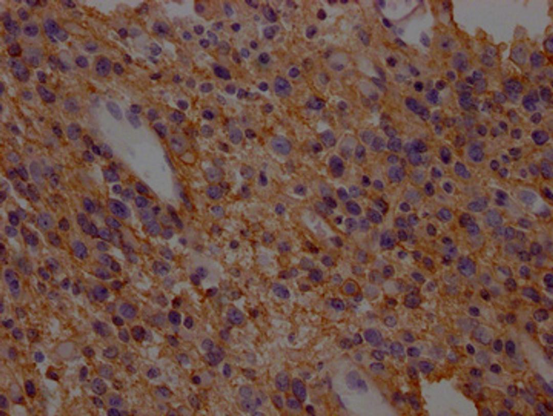 IHC image of CSB-PA021434LA01HU diluted at 1:200 and staining in paraffin-embedded human glioma cancer performed on a Leica BondTM system. After dewaxing and hydration, antigen retrieval was mediated by high pressure in a citrate buffer (pH 6.0). Section was blocked with 10% normal goat serum 30min at RT. Then primary antibody (1% BSA) was incubated at 4°C overnight. The primary is detected by a Goat anti-rabbit polymer IgG labeled by HRP and visualized using 0.05% DAB.
