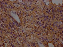 IHC image of CSB-PA021434LA01HU diluted at 1:200 and staining in paraffin-embedded human glioma cancer performed on a Leica BondTM system. After dewaxing and hydration, antigen retrieval was mediated by high pressure in a citrate buffer (pH 6.0). Section was blocked with 10% normal goat serum 30min at RT. Then primary antibody (1% BSA) was incubated at 4°C overnight. The primary is detected by a Goat anti-rabbit polymer IgG labeled by HRP and visualized using 0.05% DAB.