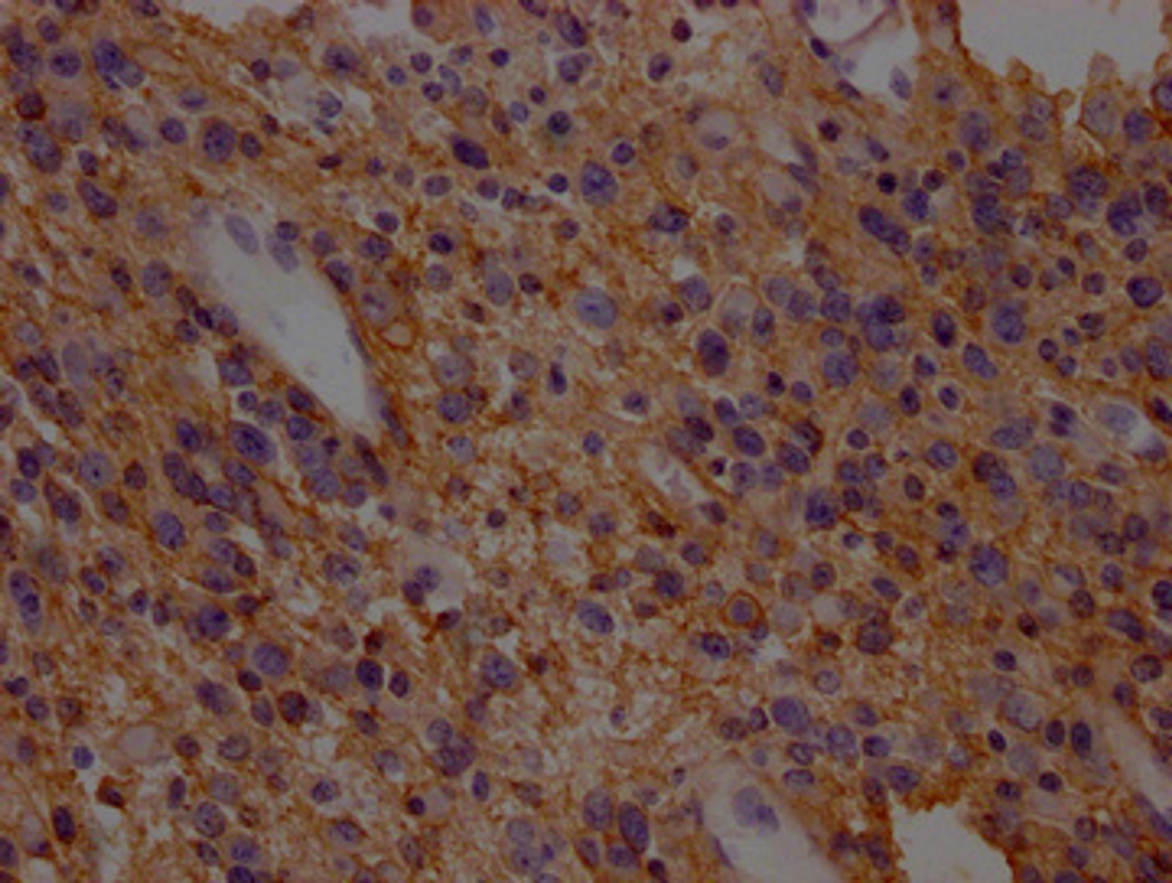 IHC image of CSB-PA021434LA01HU diluted at 1:200 and staining in paraffin-embedded human glioma cancer performed on a Leica BondTM system. After dewaxing and hydration, antigen retrieval was mediated by high pressure in a citrate buffer (pH 6.0). Section was blocked with 10% normal goat serum 30min at RT. Then primary antibody (1% BSA) was incubated at 4°C overnight. The primary is detected by a Goat anti-rabbit polymer IgG labeled by HRP and visualized using 0.05% DAB.