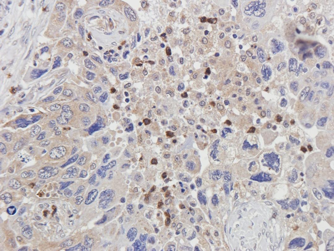 IHC-P staining of human lung cancer tissue using bFGF antibody (2.5 ug/ml)