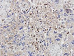 IHC-P staining of human lung cancer tissue using bFGF antibody (2.5 ug/ml)