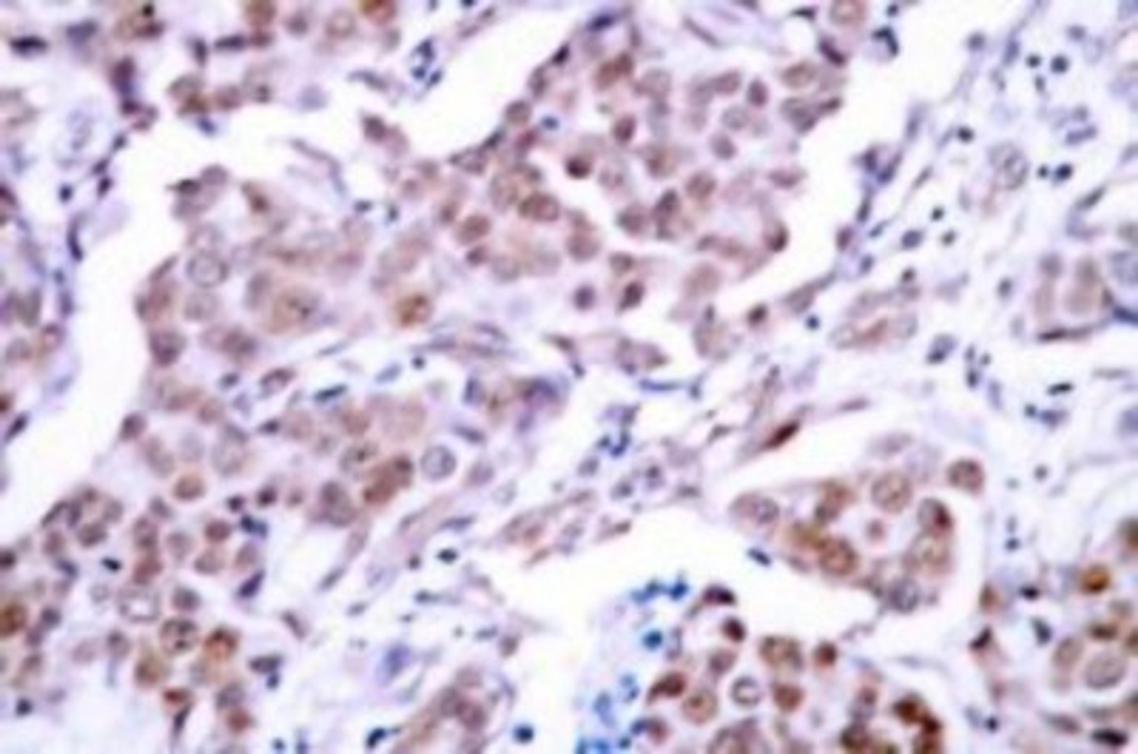 Immunohistochemistry: p53 [p Ser15] Antibody [NB100-92601] - Immunohistochemistry (IHC) analyzes of p-p53 (S15)  antibody in paraffin-embedded human breast carcinoma  tissue.