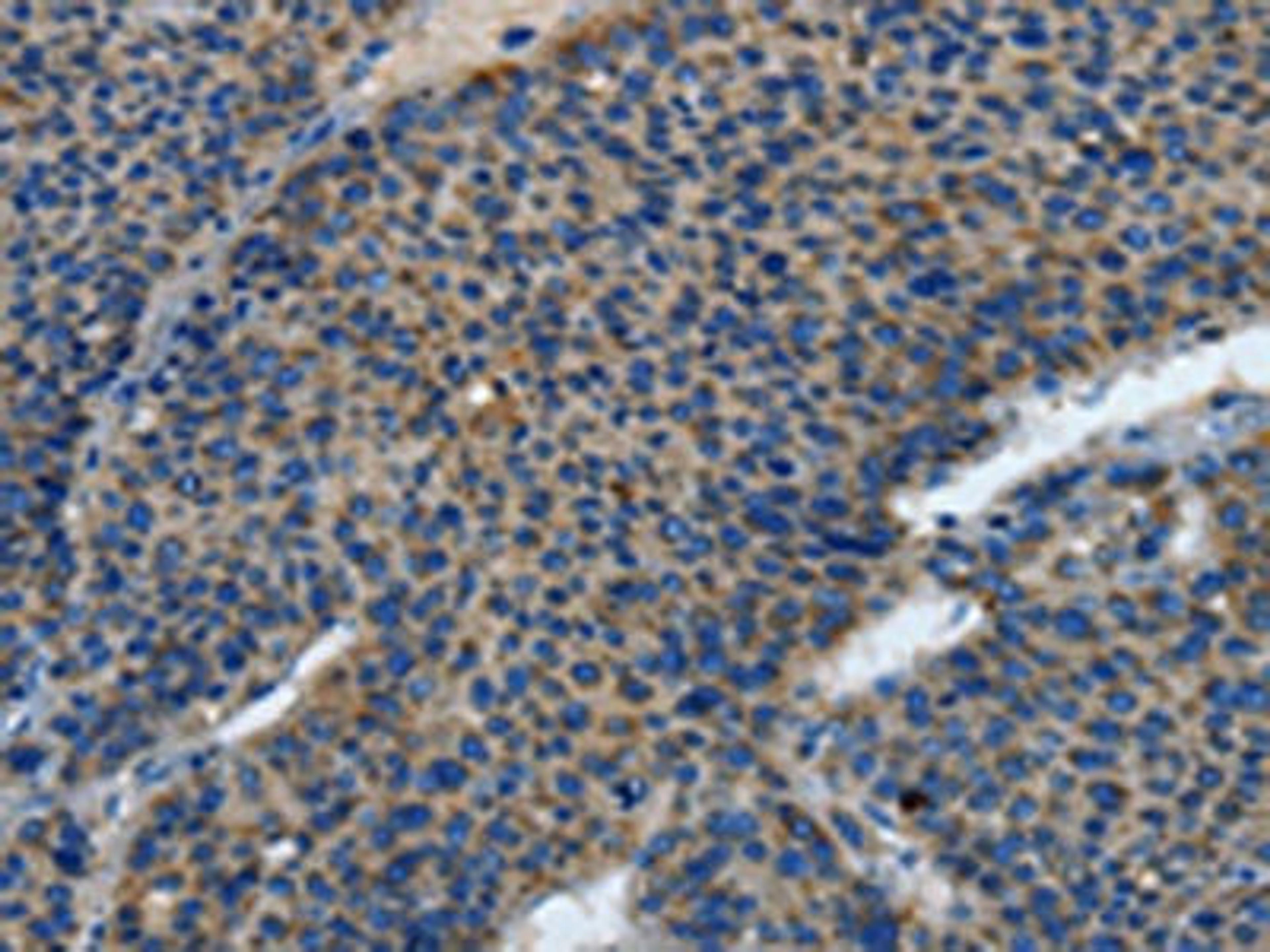 The image is immunohistochemistry of paraffin-embedded human liver cancer tissue using CSB-PA902590(TLR4 Antibody) at dilution 1/25. (Original magnification: ×200)