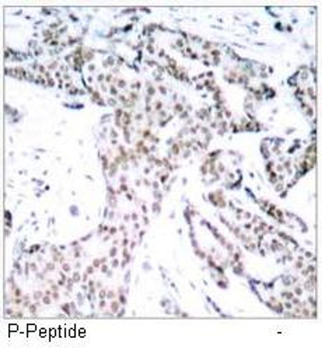 Immunohistochemical analysis of paraffin- embedded human breast carcinoma tissue using STAT3 (phospho-Ser727) antibody