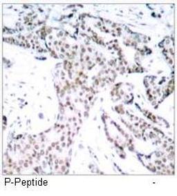 Immunohistochemical analysis of paraffin- embedded human breast carcinoma tissue using STAT3 (phospho-Ser727) antibody