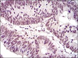 Immunohistochemistry: NCK1 Antibody (5B7) [NBP2-37490] - Immunohistochemical analysis of paraffin-embedded rectum cancer tissues using NCK1 mouse mAb with DAB staining.