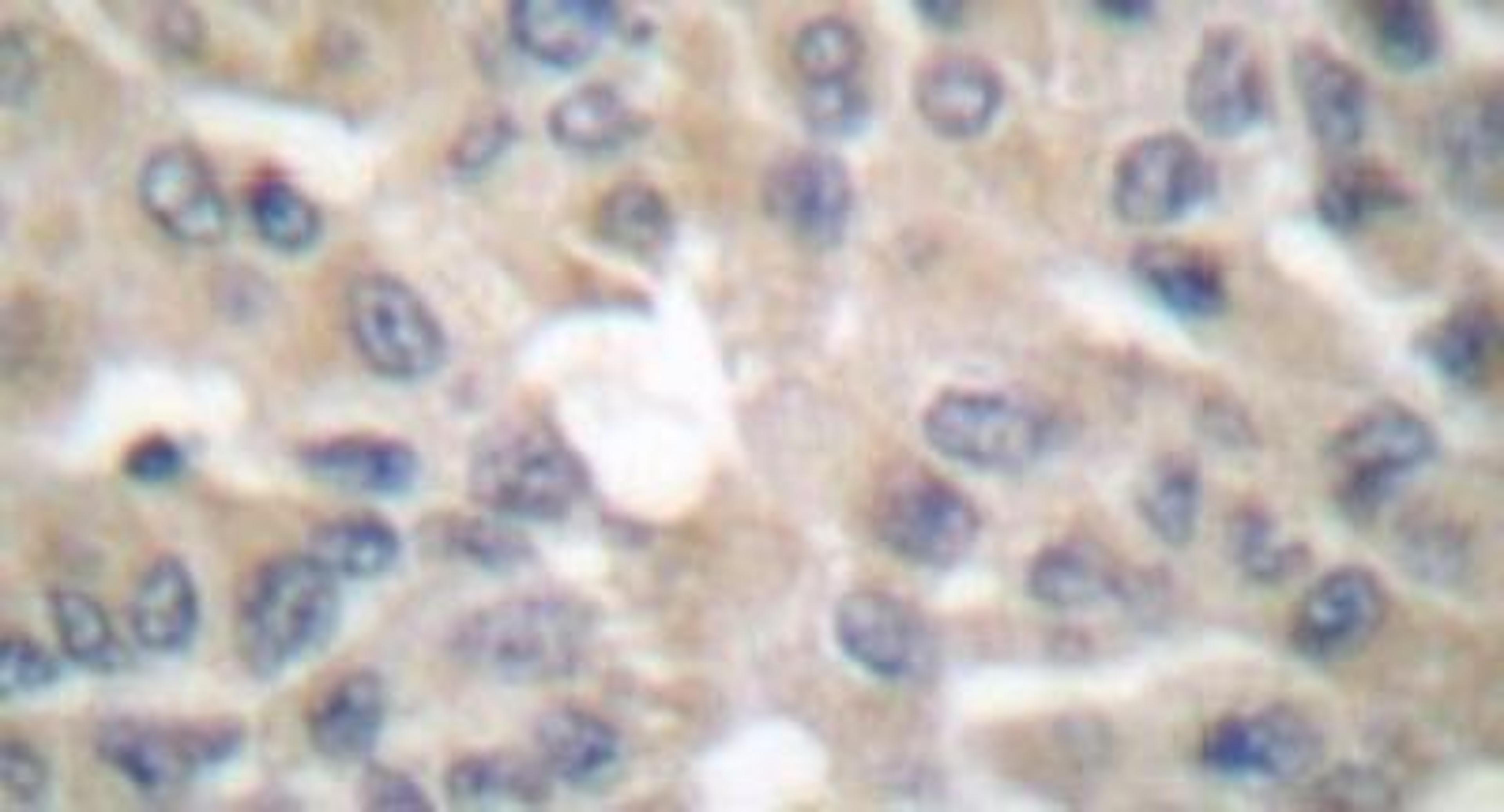 Immunohistochemistry: Acetyl-CoA Carboxylase alpha/ACACA Antibody [NB100-92012] - Acetyl Coenzyme A Carboxylase Alpha Antibody [NB100-92012] - Paraffin-embedded human  breast carcinoma colon carcinoma tissue.