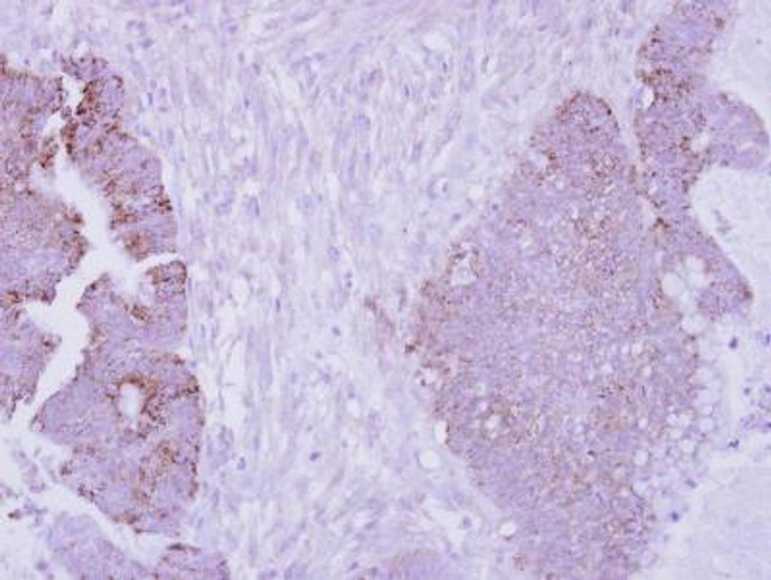 Immunohistochemistry-Paraffin: ARG2 Antibody [NBP2-15446] - Analysis of paraffin-embedded Colon ca.