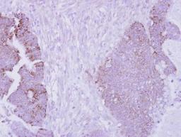 Immunohistochemistry-Paraffin: ARG2 Antibody [NBP2-15446] - Analysis of paraffin-embedded Colon ca.