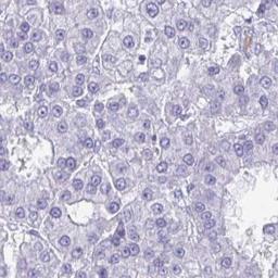 Immunohistochemistry: SMIM9 Antibody [NBP2-32578] - liver cancer