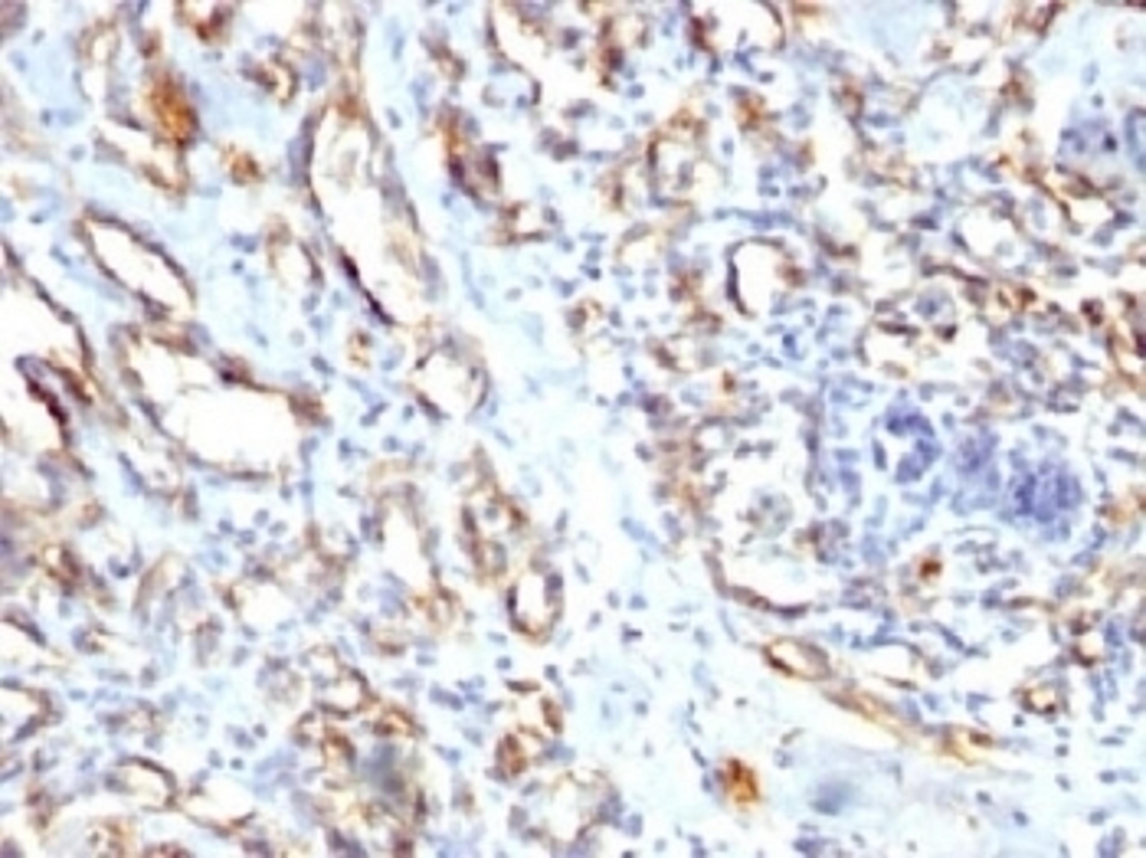 IHC staining of FFPE human angiocarcinoma with CD31 antibody. HIER: steam sections in pH7.5-8.5, 1mM EDTA for 10-20 min.
