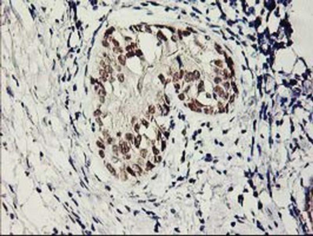 Immunohistochemistry-Paraffin: SERPINB13 Antibody (2B6) [NBP2-01312] - Staining of paraffin-embedded Adenocarcinoma of Human breast tissue using anti-SERPINB13 mouse monoclonal antibody.