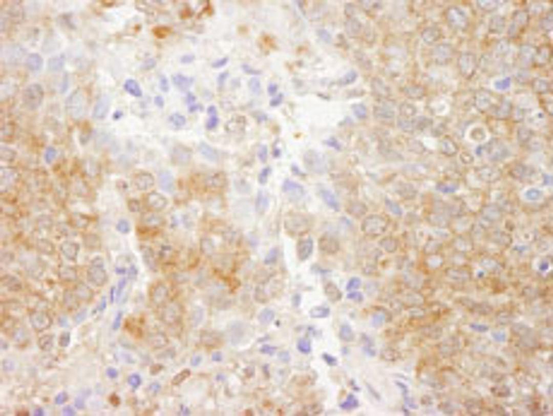 Detection of human PTEN by immunohistochemistry.