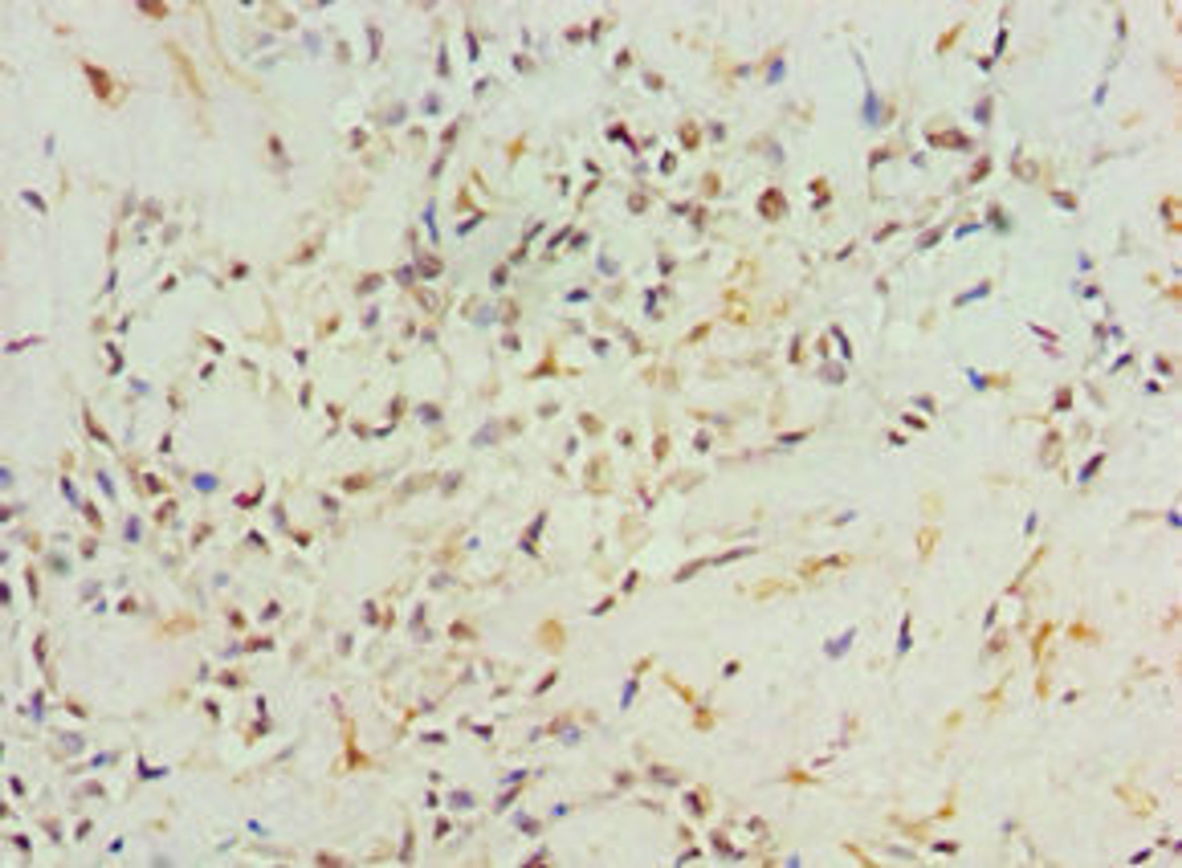 Immunohistochemistry of paraffin-embedded human breast cancer using CSB-PA001458ESR2HU at dilution of 1:100