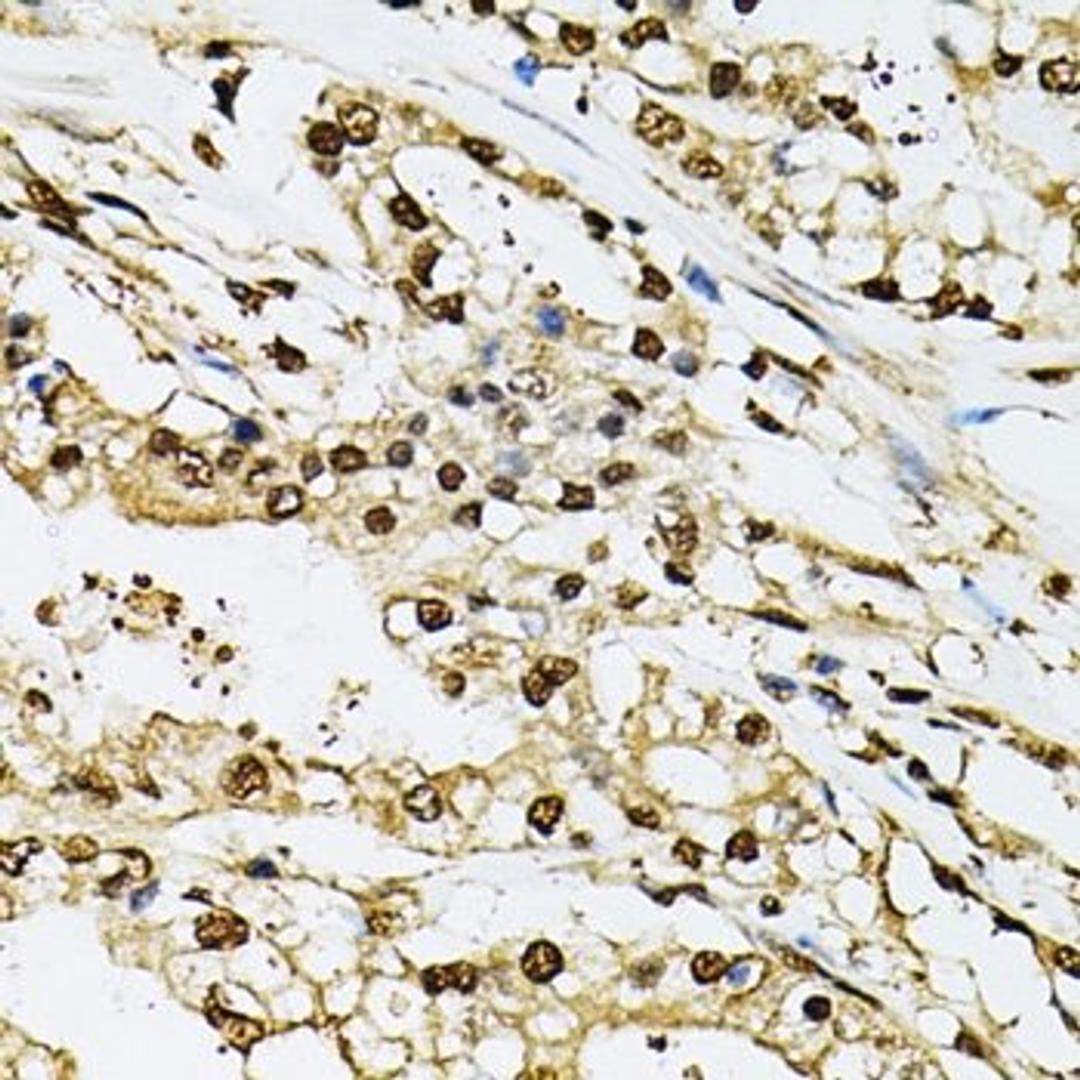 Immunohistochemistry of paraffin-embedded human prostate cancer tissue using PSMB1 antibody