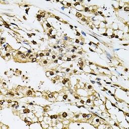 Immunohistochemistry of paraffin-embedded human prostate cancer tissue using PSMB1 antibody