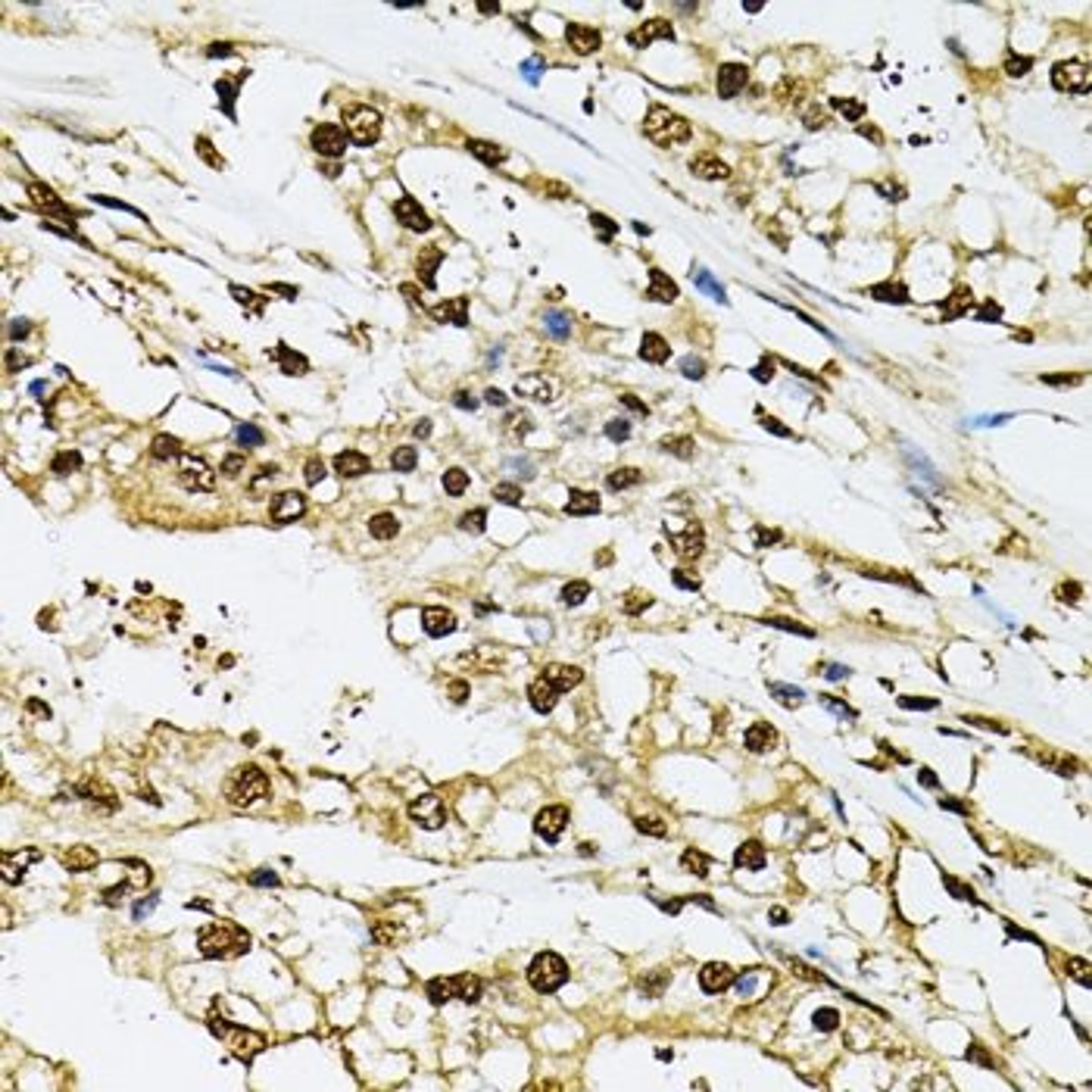 Immunohistochemistry of paraffin-embedded human prostate cancer tissue using PSMB1 antibody
