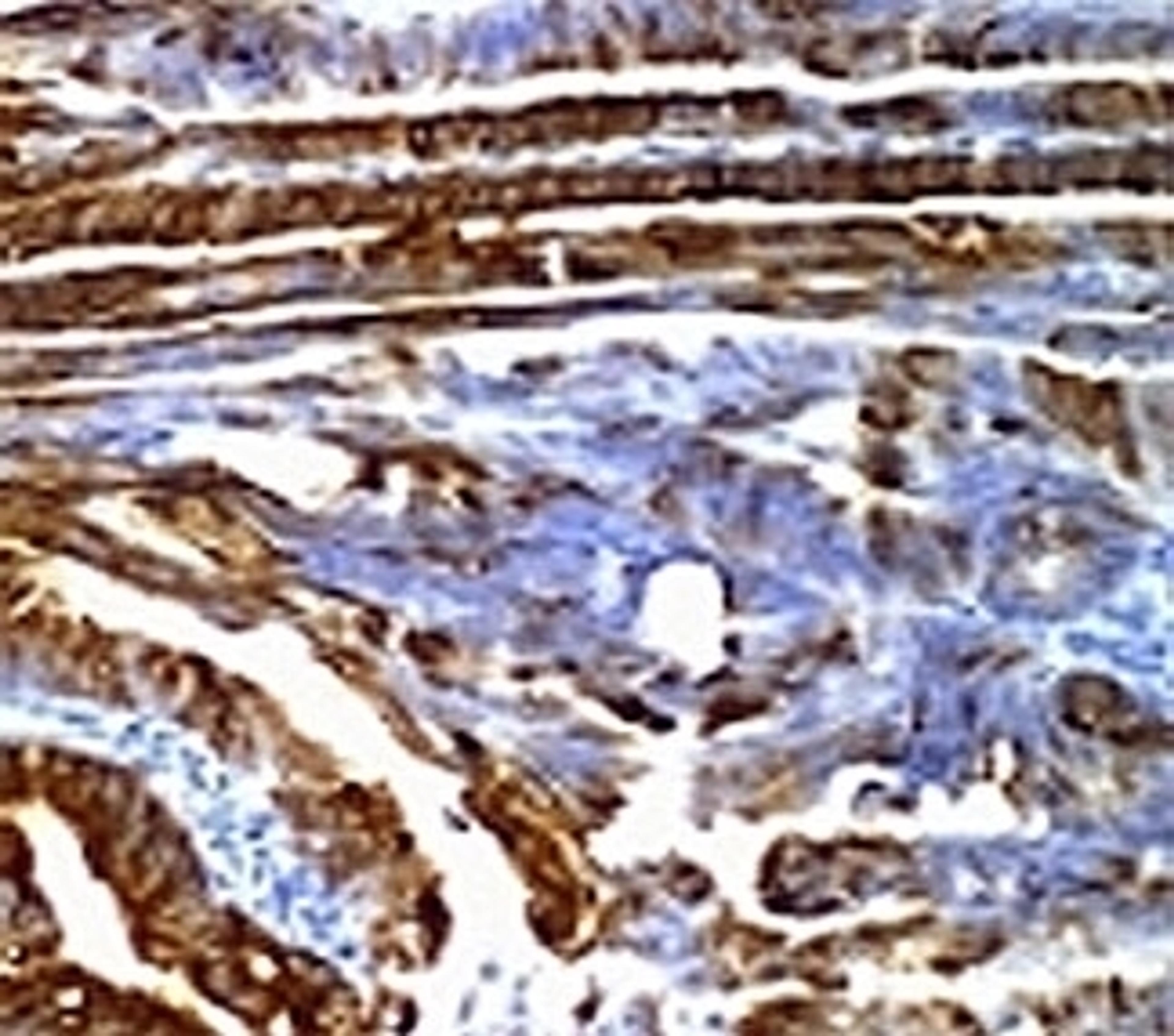 Formalin-fixed, paraffin-embedded human colon carcinoma stained with MUC2 antibody (SPM296).