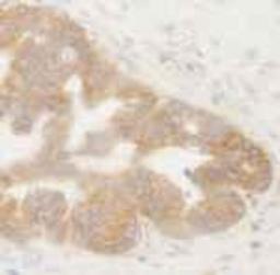 Immunohistochemistry-Paraffin: BIRC6 Antibody [NB300-264] - Human ovarian tumor.  Affinity purified rabbit anti-BIRC6/Apollon used at a dilution of 1:250.