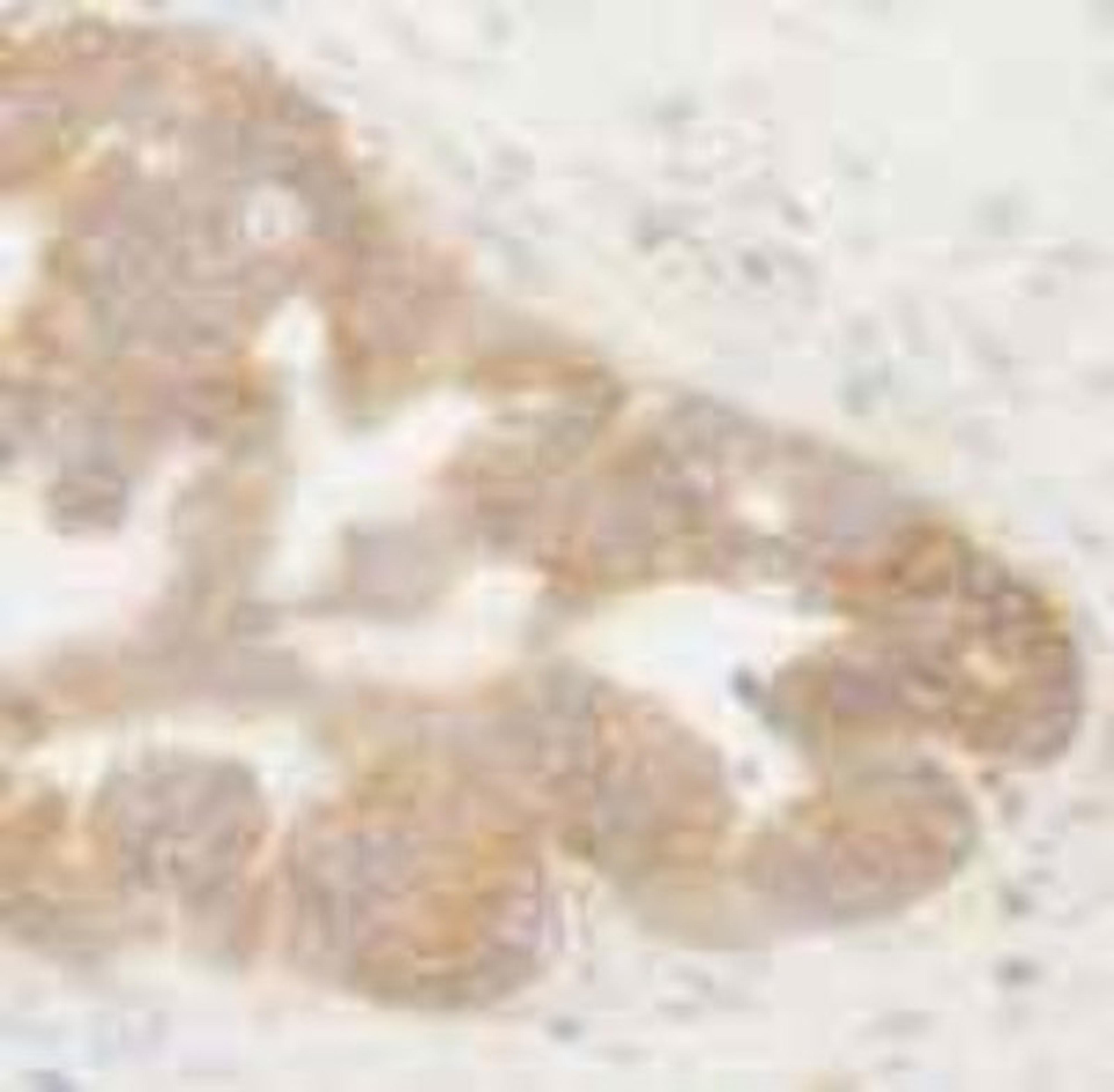 Immunohistochemistry-Paraffin: BIRC6 Antibody [NB300-264] - Human ovarian tumor.  Affinity purified rabbit anti-BIRC6/Apollon used at a dilution of 1:250.