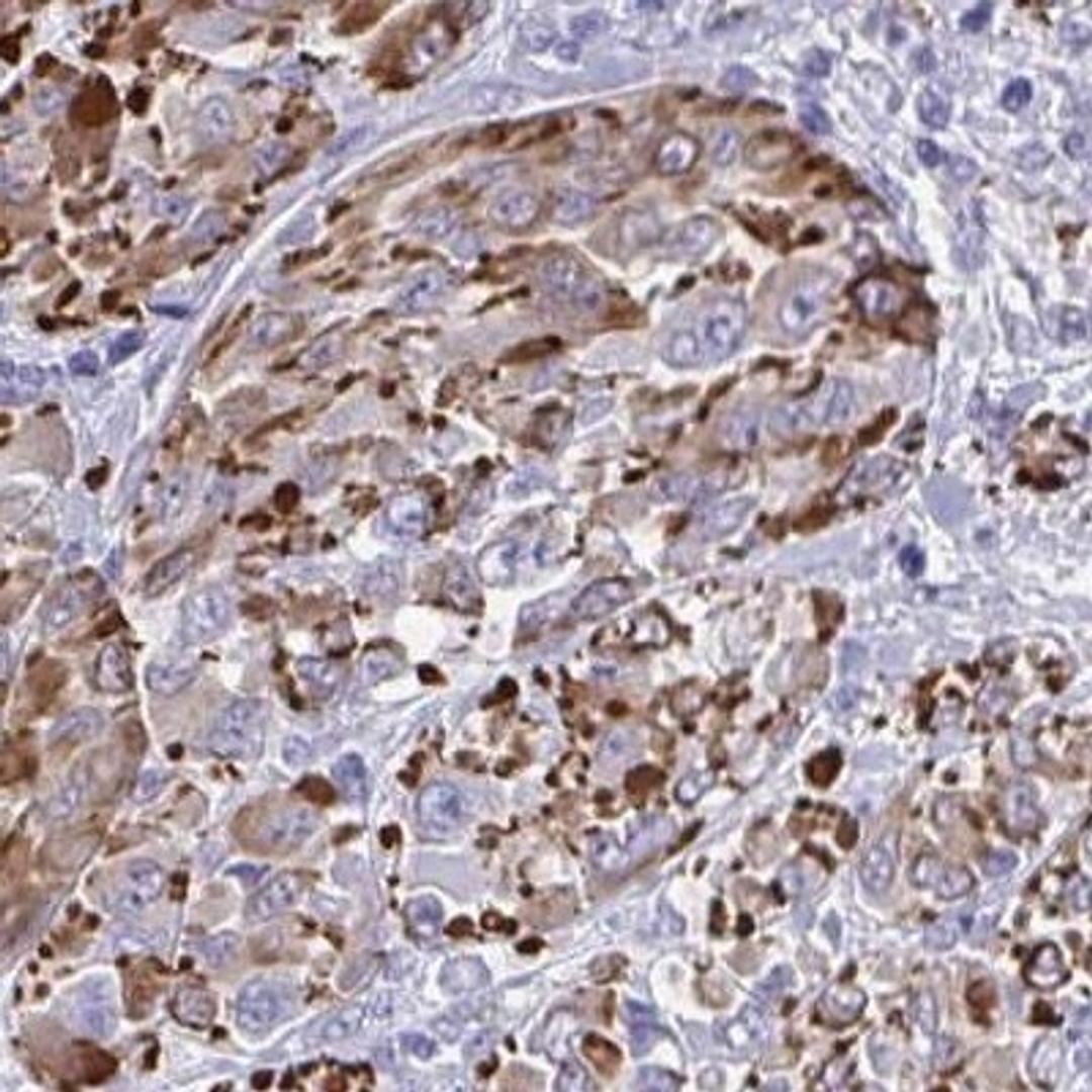 Immunohistochemistry: SLC35B1 Antibody [NBP2-31677] - melanoma