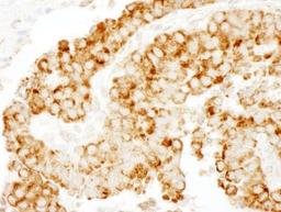 Immunohistochemistry-Paraffin: CKAP4 Antibody [NBP1-26642] - Human breast carcinoma. Antibody used at a dilution of 1:200 (1ug/ml).