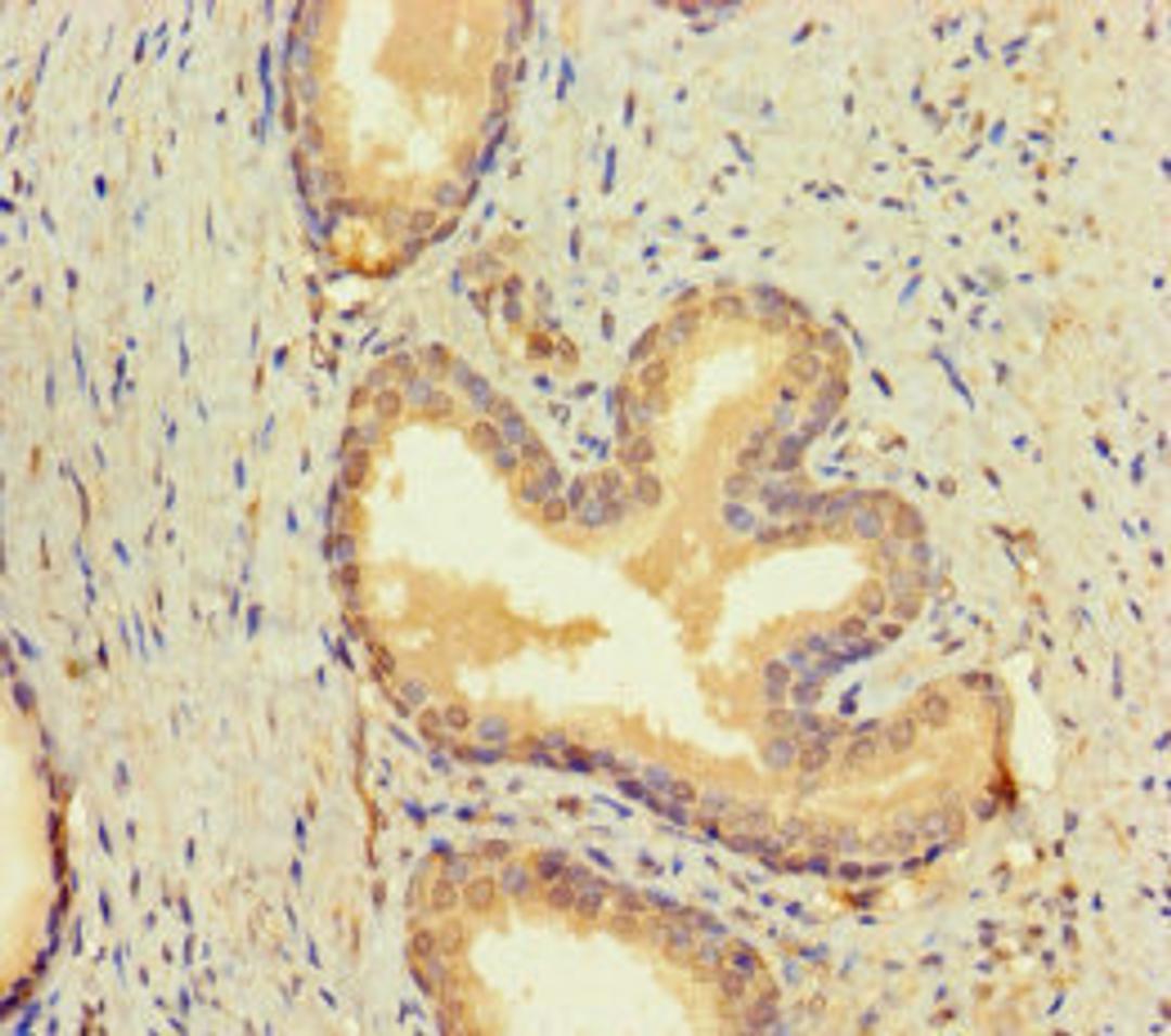 Immunohistochemistry of paraffin-embedded human prostate cancer using CSB-PA05799A0Rb at dilution of 1:100