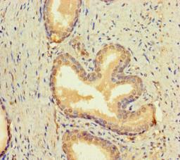 Immunohistochemistry of paraffin-embedded human prostate cancer using CSB-PA05799A0Rb at dilution of 1:100