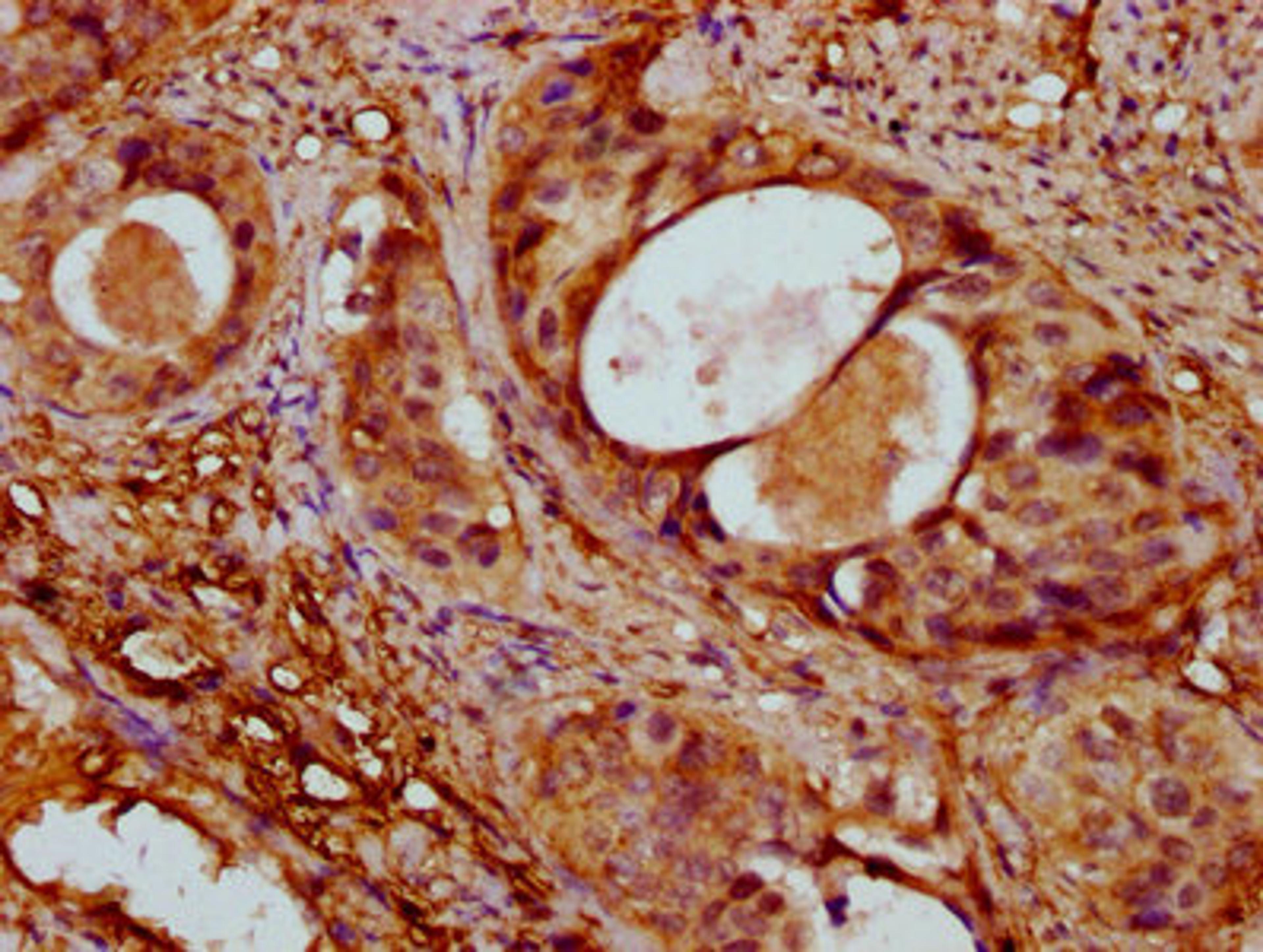 IHC image of CSB-PA001205NJ01HU diluted at 1:400 and staining in paraffin-embedded human cervical cancer performed on a Leica BondTM system. After dewaxing and hydration, antigen retrieval was mediated by high pressure in a citrate buffer (pH 6.0). Section was blocked with 10% normal goat serum 30min at RT. Then primary antibody (1% BSA) was incubated at 4&deg;C overnight. The primary is detected by a biotinylated secondary antibody and visualized using an HRP conjugated SP system.