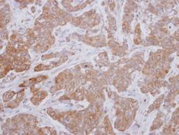 Immunohistochemistry-Paraffin: MAP3K12 Antibody [NBP2-17218] - Analysis of paraffin-embedded Breast ca, using antibody at 1:250 dilution.