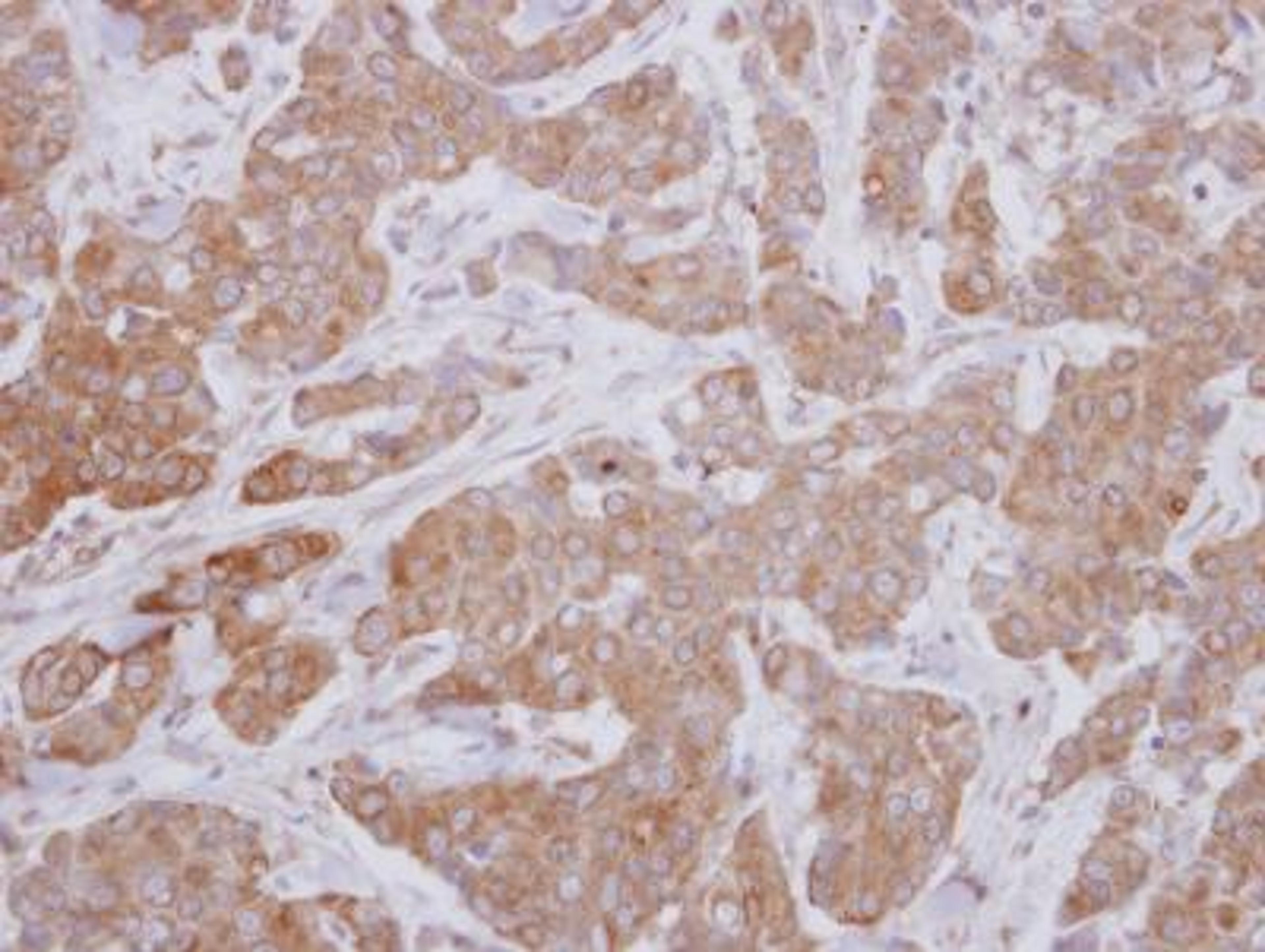 Immunohistochemistry-Paraffin: MAP3K12 Antibody [NBP2-17218] - Analysis of paraffin-embedded Breast ca, using antibody at 1:250 dilution.