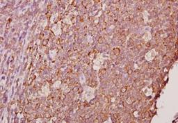 Immunohistochemistry-Paraffin: Ephrin-A1 Antibody [NBP1-30503] - Paraffin-embedded human tonsil carcinoma tissue at 1:50.