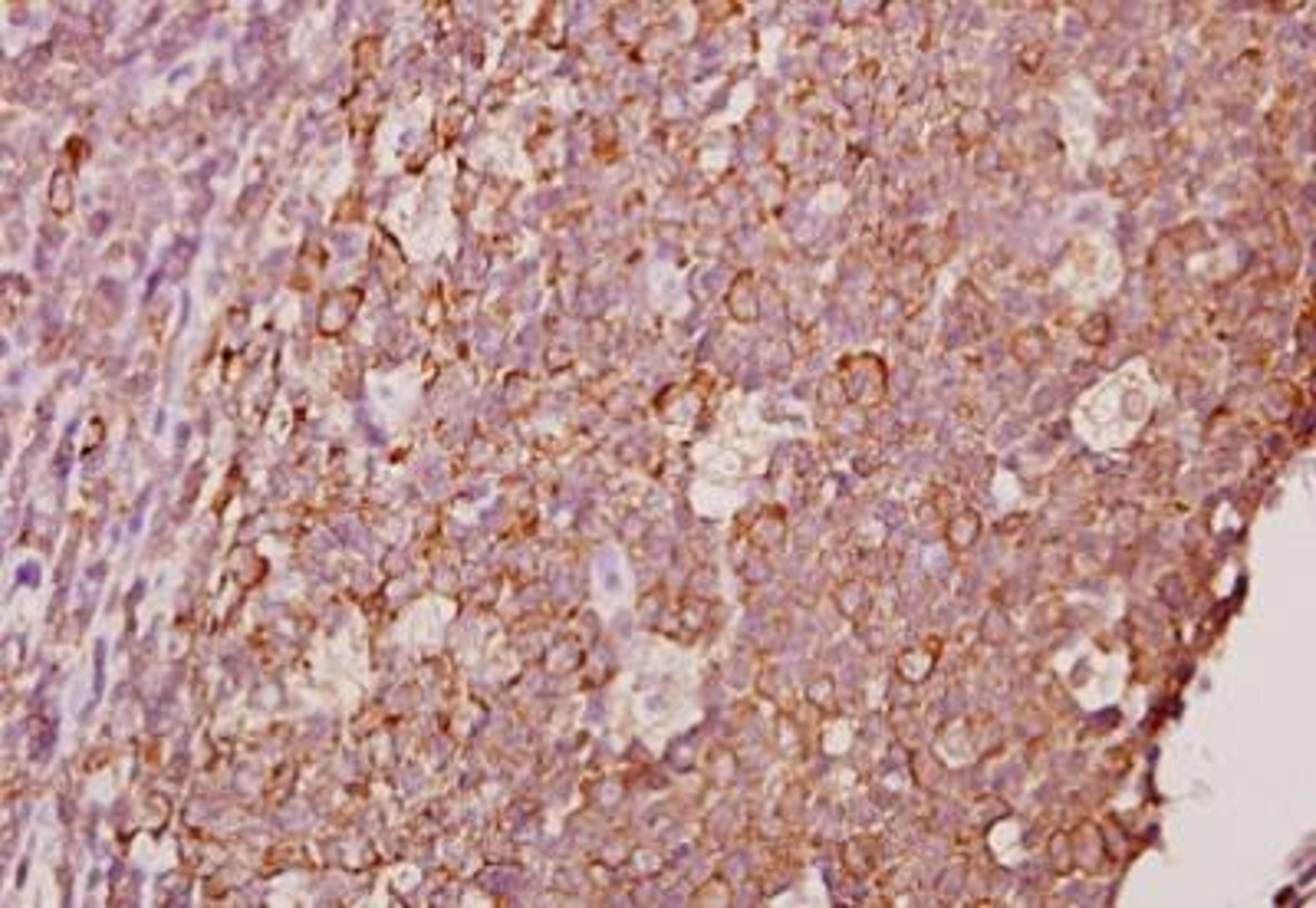 Immunohistochemistry-Paraffin: Ephrin-A1 Antibody [NBP1-30503] - Paraffin-embedded human tonsil carcinoma tissue at 1:50.