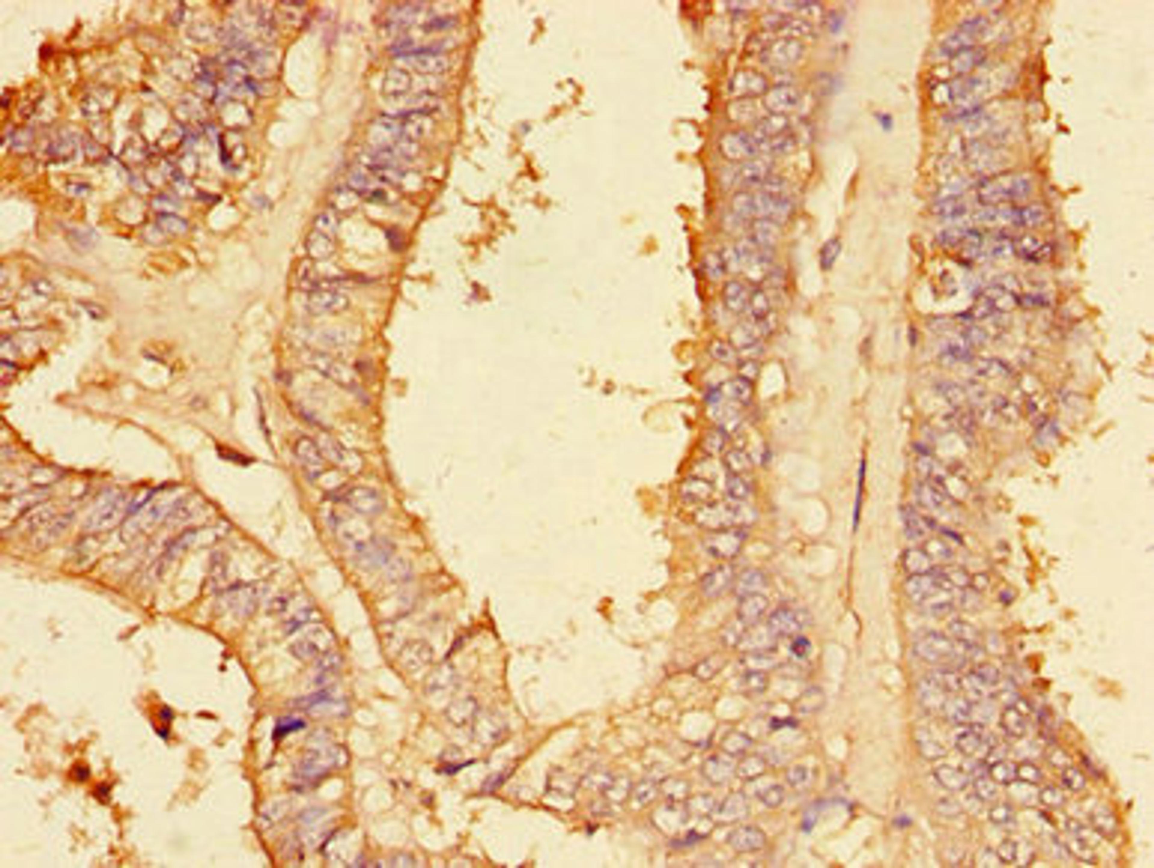 Immunohistochemistry of paraffin-embedded human endometrial cancer using CSB-PA018097LA01HU at dilution of 1:100
