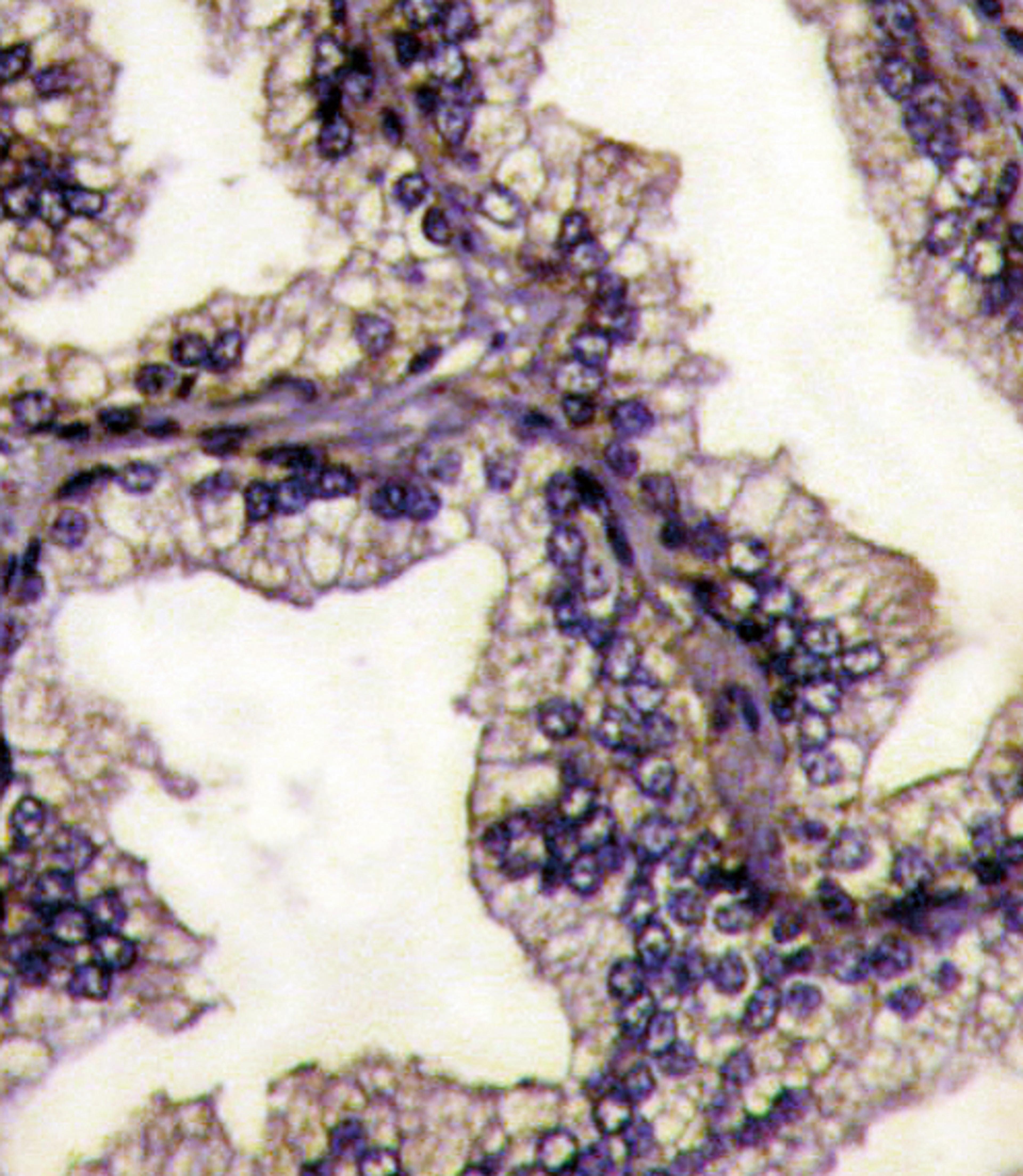 Formalin-fixed and paraffin-embedded prostata carcinoma tissue reacted with LTF Antibody , which was peroxidase-conjugated to the secondary antibody, followed by DAB staining.