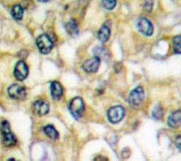 Immunohistochemistry-Paraffin: FGFR3 Antibody [NB100-91767] - Paraffin-embedded human breast carcinoma tissue.