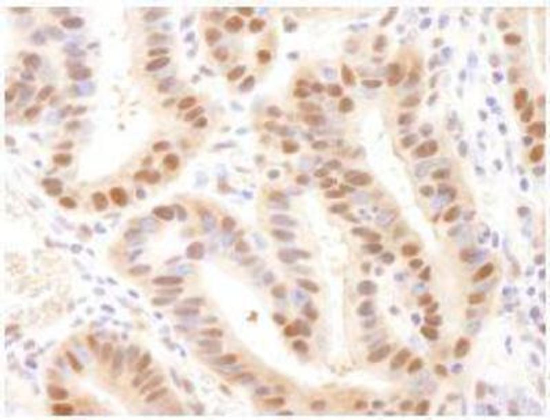 Immunohistochemistry-Paraffin: UBE2A Antibody [NB100-553] - FFPE section of human stomach adenocarcinoma.  Affinity purified rabbit anti-Rad6 used at a dilution of 1:250.