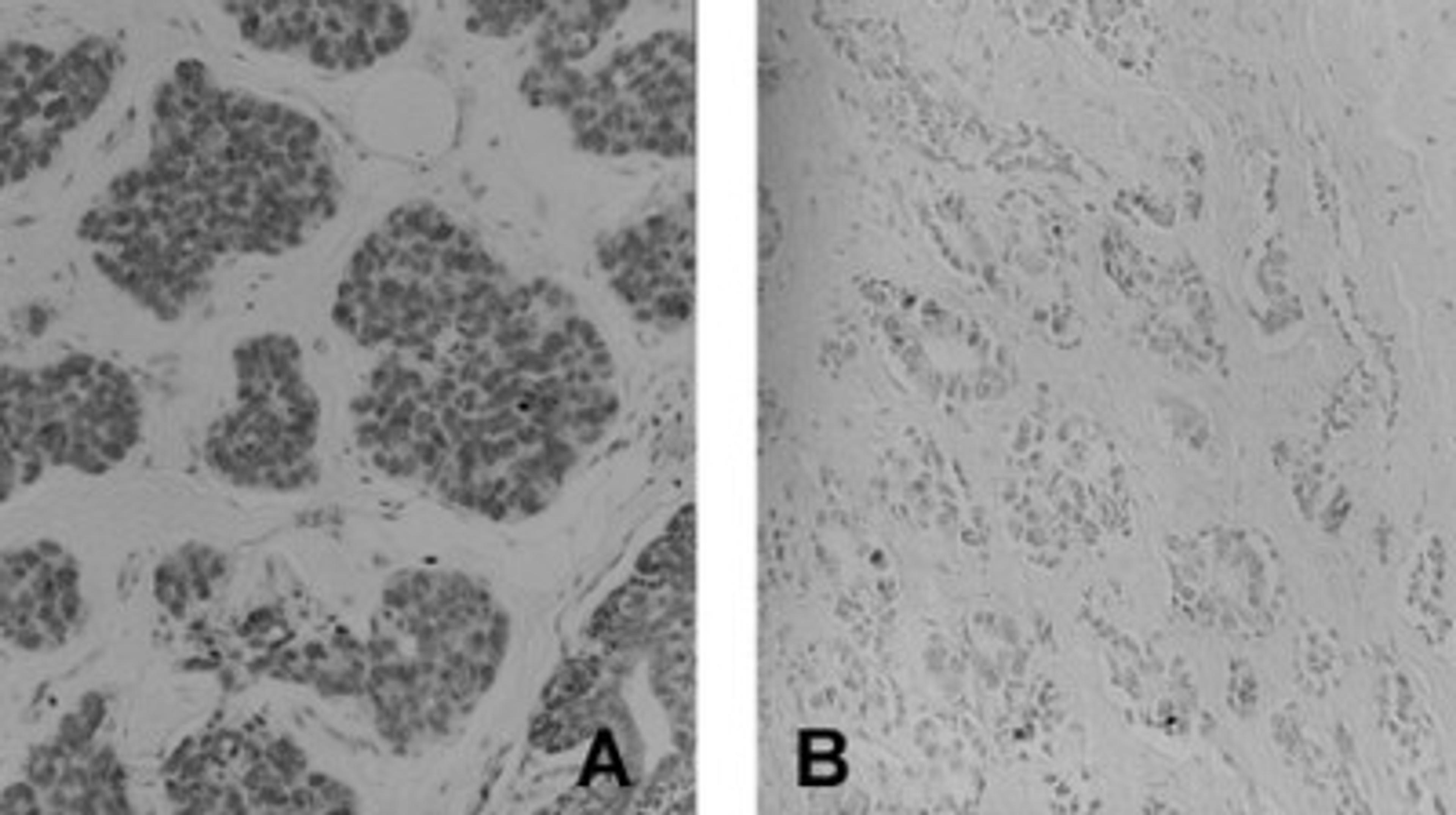 Immunohistochemistry: 4-amino Biphenyl DNA Antibody (4C11) [NB100-415] - Human breast tumor tissue with high (A) and low (B) adduct levels. Images courtesy of Dr. Regina Santella.