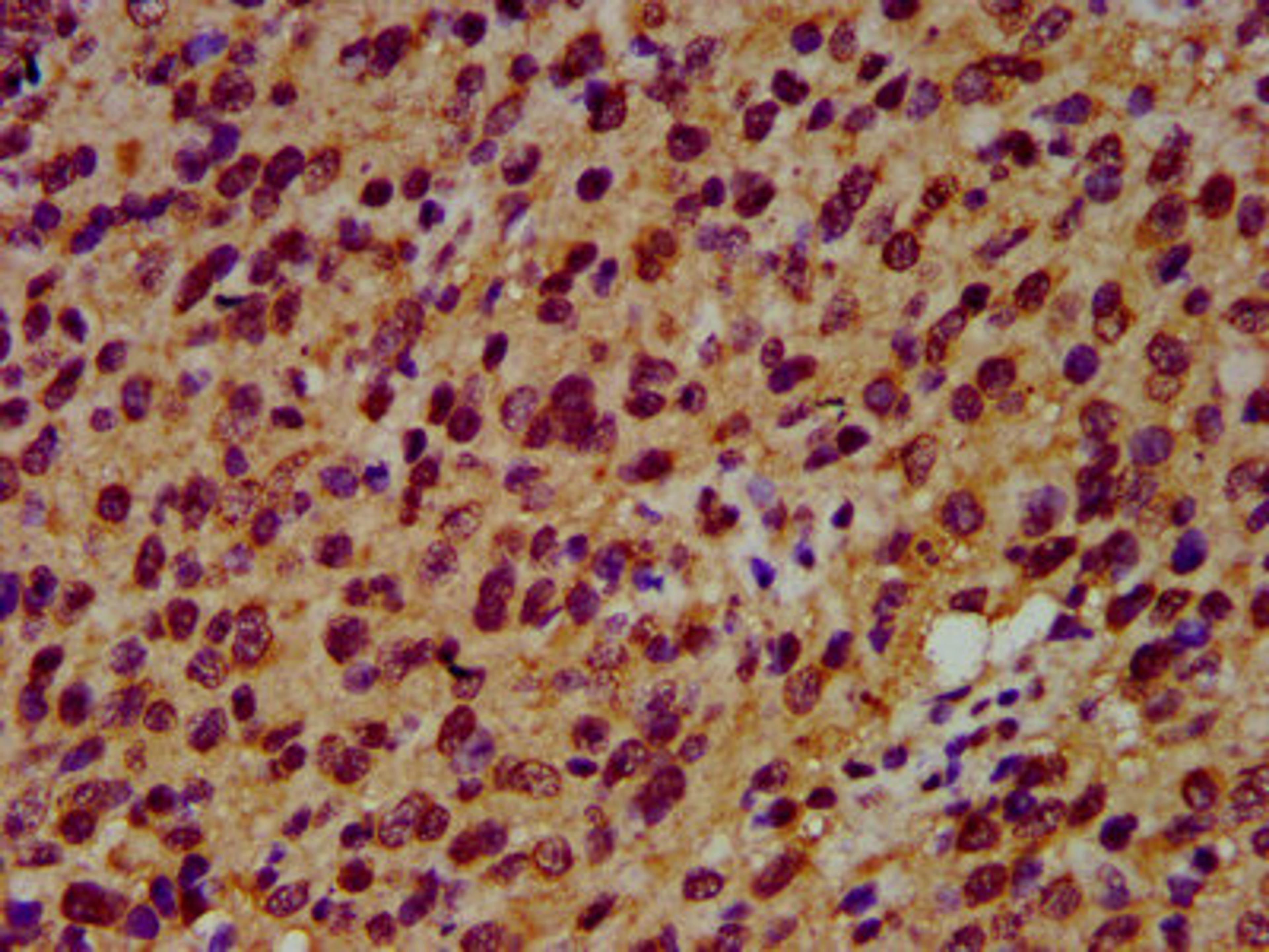 IHC image of CSB-PA021288LA01HU diluted at 1:600 and staining in paraffin-embedded human glioma performed on a Leica BondTM system. After dewaxing and hydration, antigen retrieval was mediated by high pressure in a citrate buffer (pH 6.0). Section was blocked with 10% normal goat serum 30min at RT. Then primary antibody (1% BSA) was incubated at 4°C overnight. The primary is detected by a biotinylated secondary antibody and visualized using an HRP conjugated SP system.