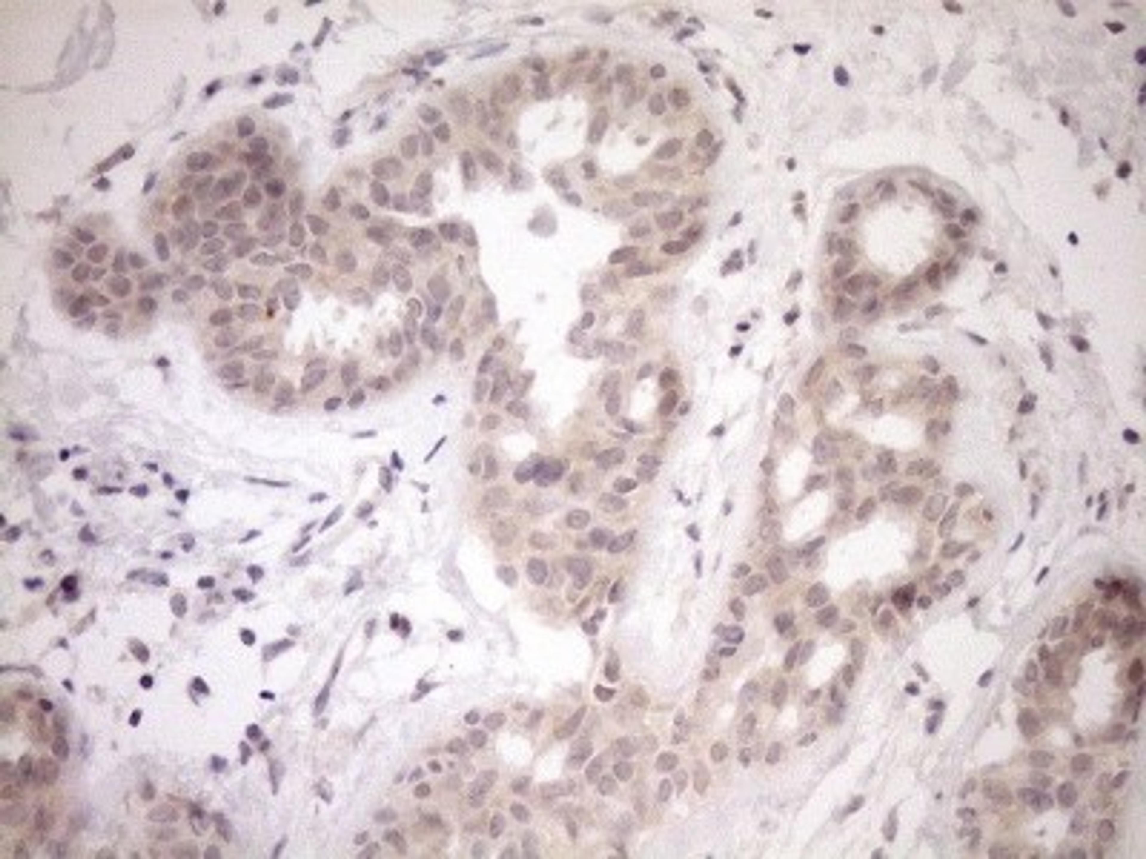 Immunohistochemistry: PARG Antibody (6F4) [NBP2-46320] - Analysis of Adenocarcinoma of Human breast tissue. (Heat-induced epitope retrieval by 1mM EDTA in 10mM Tris buffer (pH8.5) at 120C for 3 min)