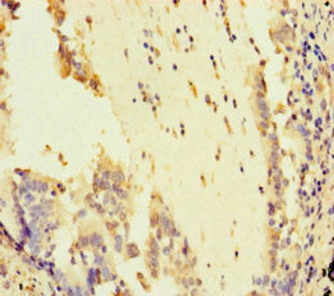Immunohistochemistry of paraffin-embedded human lung cancer using CSB-PA622666LA01HU at dilution of 1:100